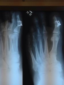 Wayne's x-ray... note the two "Plaples"